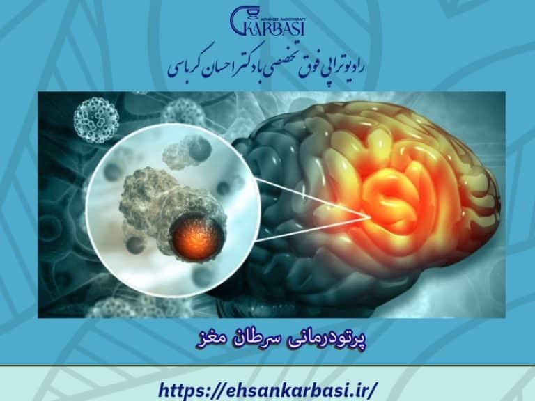 رادیوتراپی مغز | پرتودرمانی مغز 2 پرتو درمانی سرطان مغز