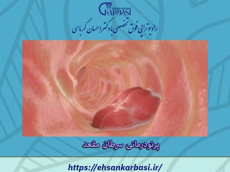 رادیوتراپی یا پرتو درمانی سرطان مقعد چگونه است؟ 2 پرتو درمانی سرطان مقعد