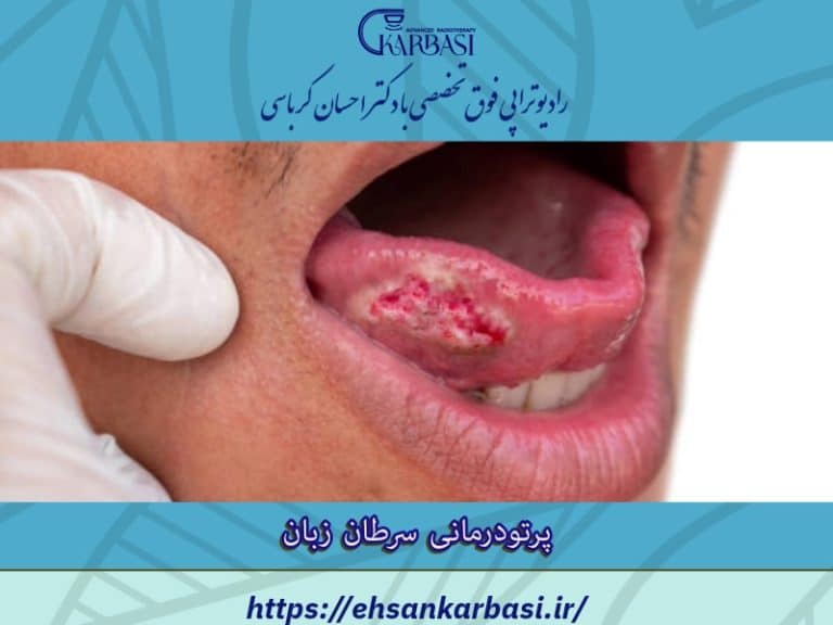 پرتودرمانی برای سرطان زبان، لوزه یا سایر اعضاء دهان و حلق چگونه است؟ 2 پرتو درمانی سرطان زبان