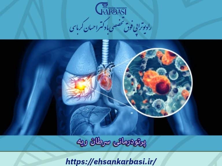 پرتودرمانی سرطان ریه | رادیوتراپی معجزه درمان سرطان ریه 2 پرتو درمانی سرطان ریه