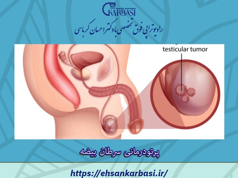 پرتودرمانی سرطان بیضه