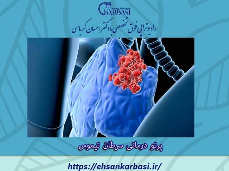 درمان سرطان غده تیموس (تیموما) با رادیوتراپی یا پرتودرمانی 2 پرتودرمانی سرطان تیموس