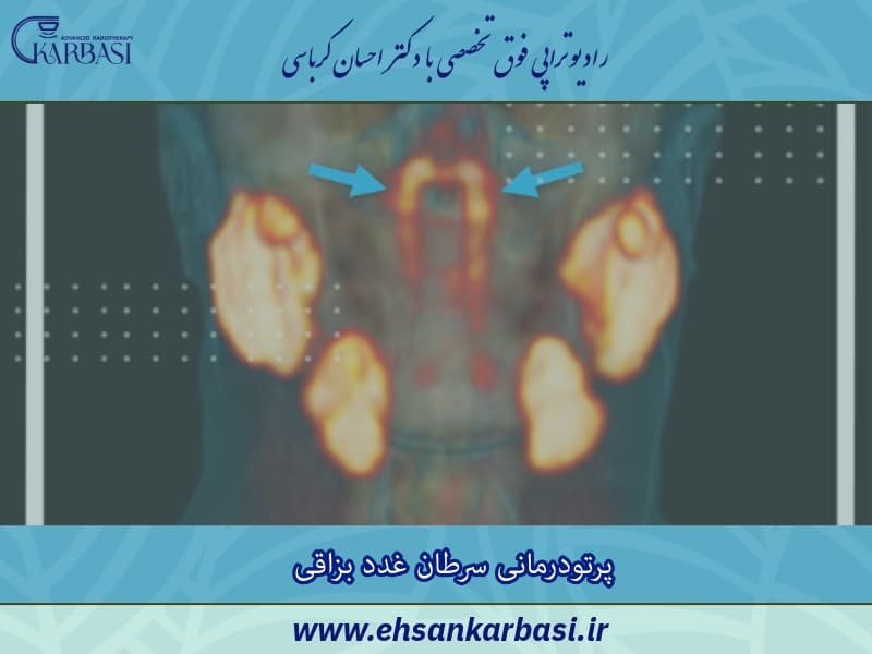 پرتودرمانی سرطان غدد بزاقی