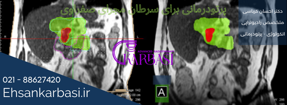 کلانژیوکارسینوما مجاری صفراوی