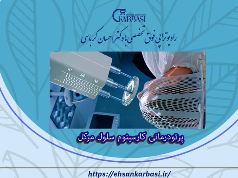 پرتودرمانی کارسینوم سلول مرکل 2 پرتودرمانی کارسینوم سلول مرکل