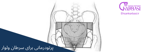 رادیوتراپی برای درمان سرطان وولو