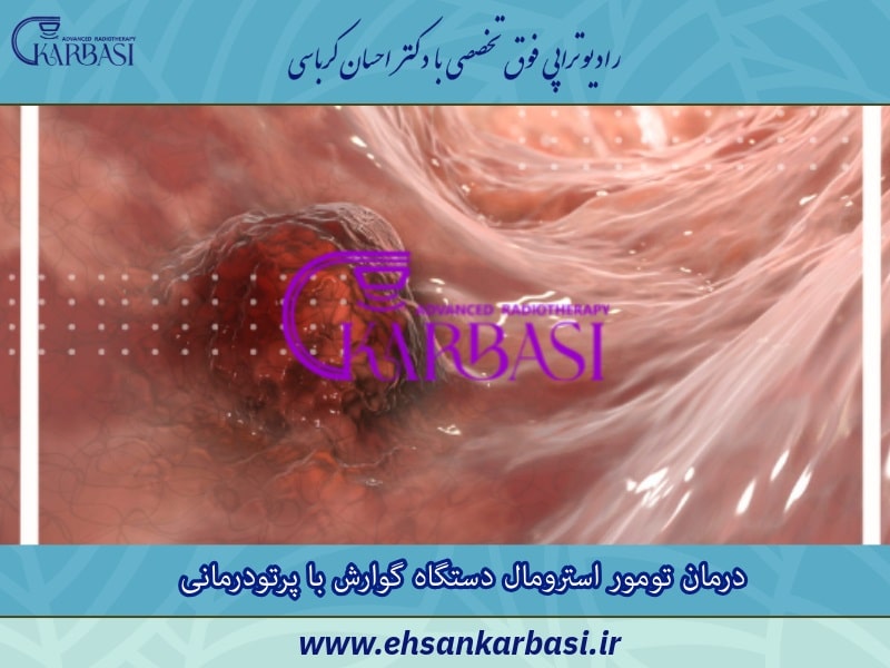 درمان تومور استرومال دستگاه گوارش با پرتودرمانی