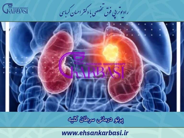 پرتو درمانی سرطان کلیه یا رادیوتراپی کلیه 2 پرتو درمانی سرطان کلیه