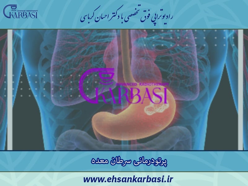 پرتودرمانی سرطان معده