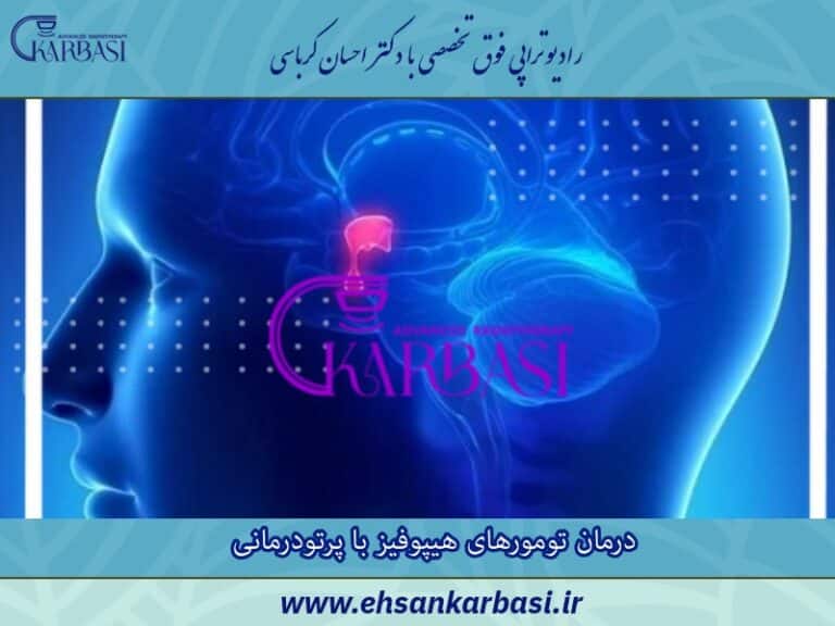 درمان تومورهای هیپوفیز با پرتودرمانی یا رادیوتراپی 2 درمان تومورهای هیپوفیز با پرتودرمانی
