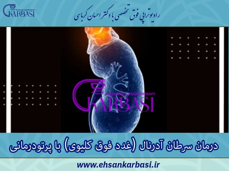 درمان سرطان آدرنال (غدد فوق کلیوی) با پرتودرمانی یا رادیوتراپی