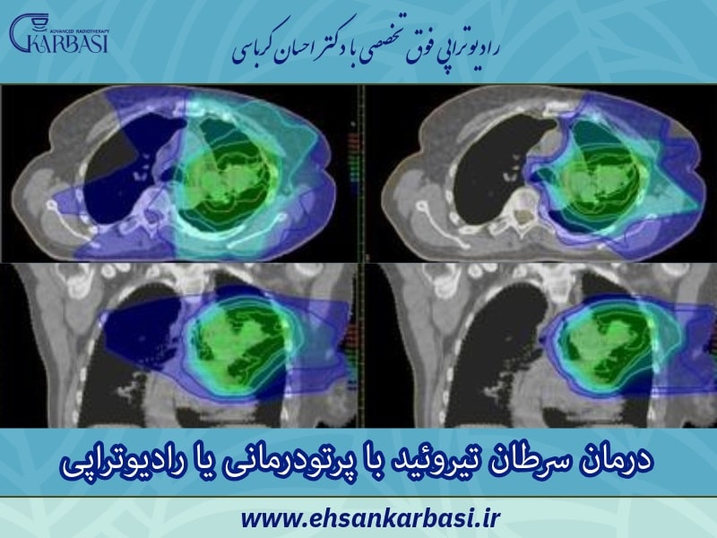 درمان سرطان تیروئید با پرتودرمانی یا رادیوتراپی
