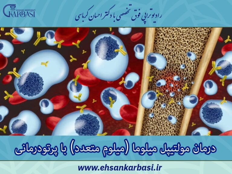 درمان مولتیپل میلوما (میلوم متعدد) با پرتودرمانی یا رادیوتراپی 2 درمان مولتیپل میلوما (میلوم متعدد) با پرتودرمانی