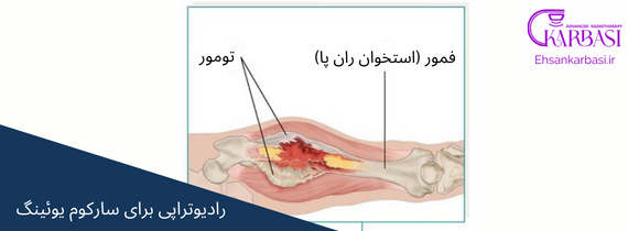 سارکوم یوئینگ