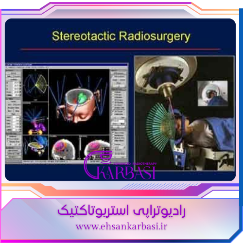 پرتو درمانی SBRT