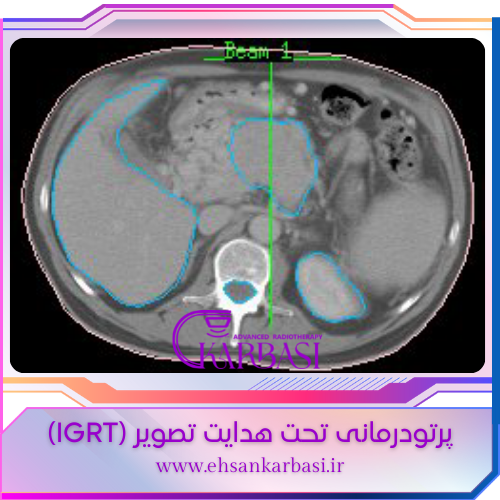 پرتو درمانی IGRT