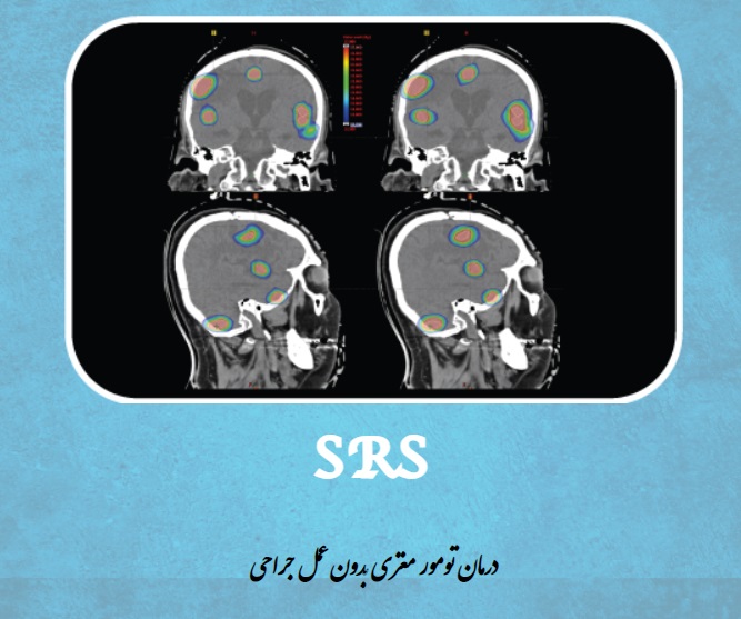 درمان تومور مغزی بدون عمل جراحی SRS
