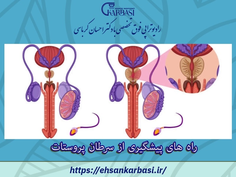 راه های پیشگیری از سرطان پروستات