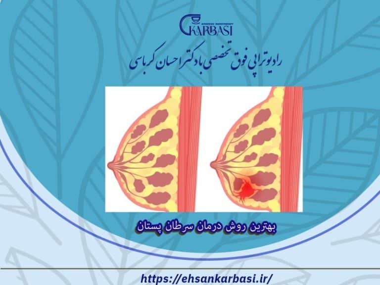 بهترین روش درمان سرطان پستان 2 بهترین روش درمان سرطان پستان