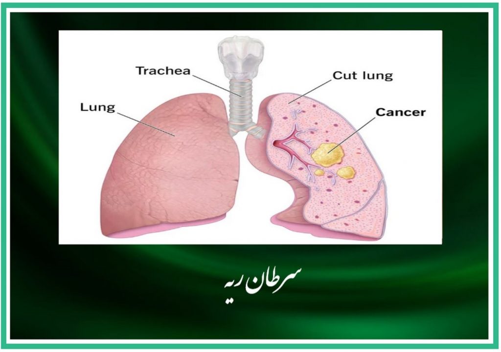 سرطان ریه