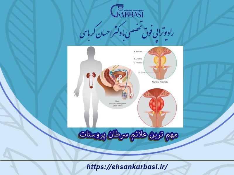 مهم ترین علائم سرطان پروستات