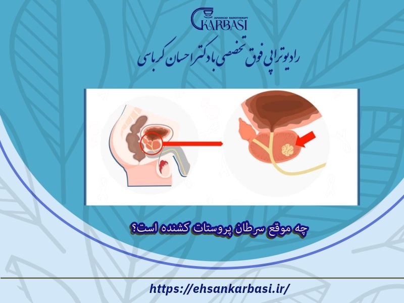 چه موقع سرطان پروستات کشنده است؟