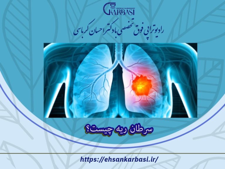 سرطان ریه چیست؟ 2 سرطان ریه چیست؟