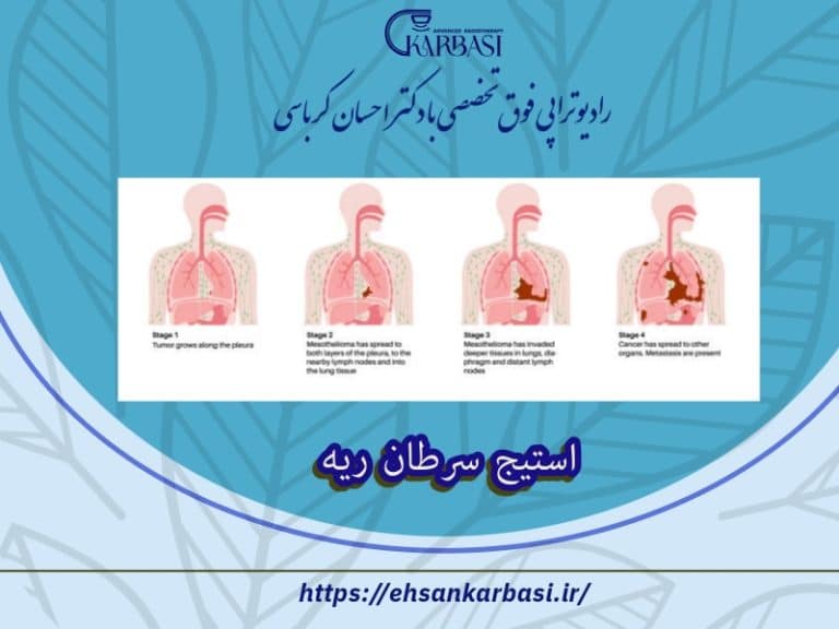 استیج سرطان ریه