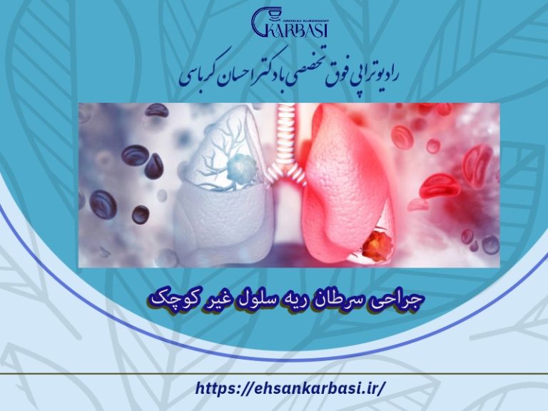 جراحی سرطان ریه سلول کوچک