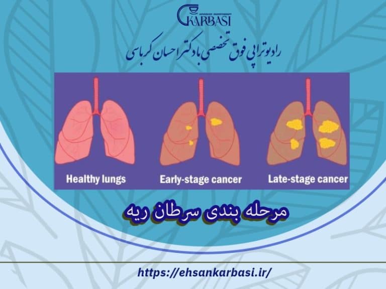 تعیین مرحله یا استیج سرطان ریه 2 مرحله بندی سرطان ریه