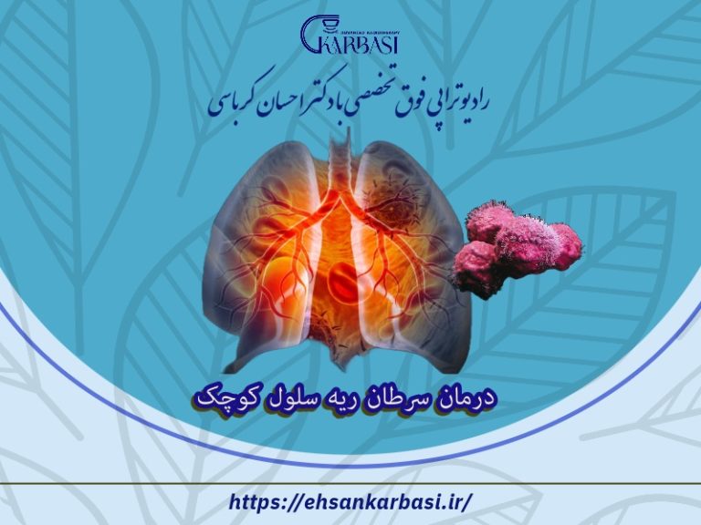 انواع روش های درمان سرطان ریه سلول کوچک (SCLC) 2 درمان سرطان ریه سلول کوچک