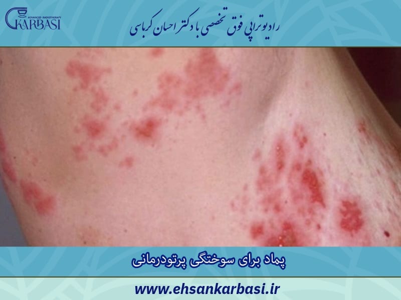 پماد برای سوختگی پرتودرمانی