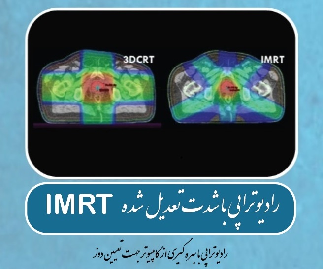 رادیوتراپی با شدت تعدیل شده