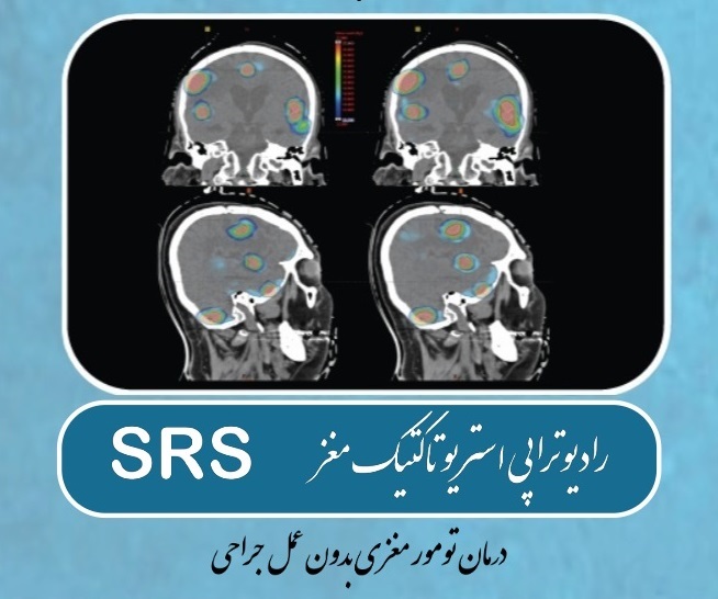 رادیوتراپی استریوتاکتیک مغز