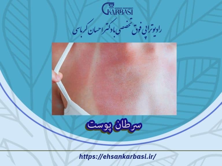 سرطان پوست چیست؟ علائم و نشانه های سرطان پوست 2 سرطان پوست
