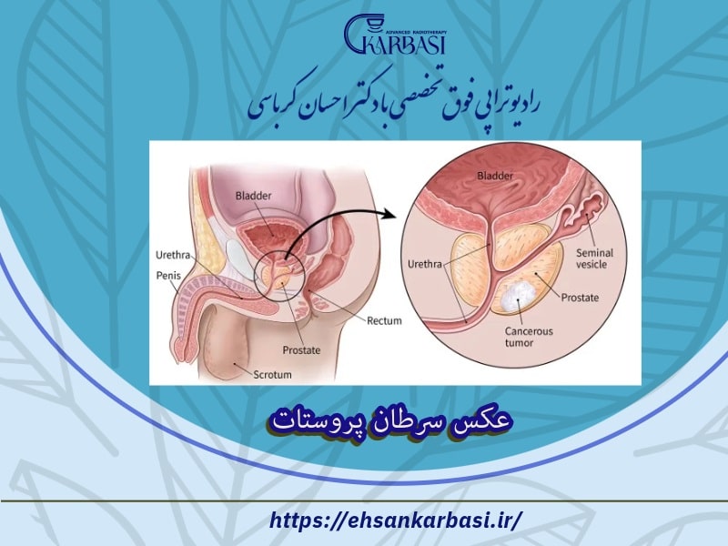 عکس سرطان پروستات