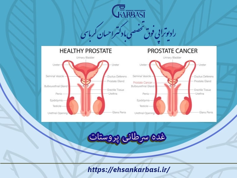 غده سرطانی پروستات