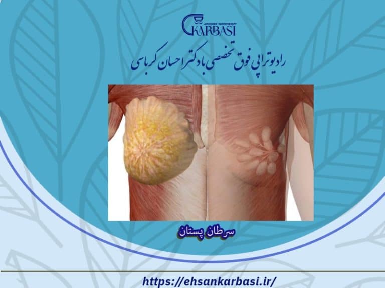 سرطان پستان چیست؟ و انواع سرطان سینه 2 سرطان پستان چیست