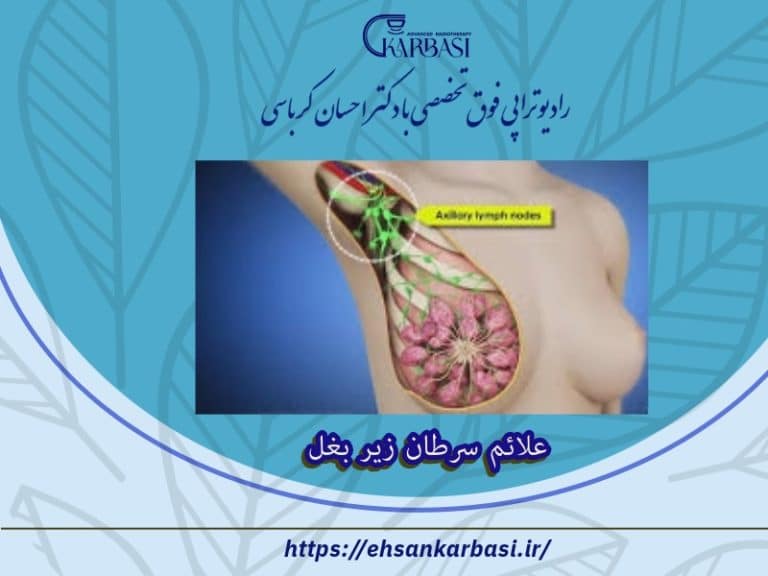 علائم سرطان زیر بغل