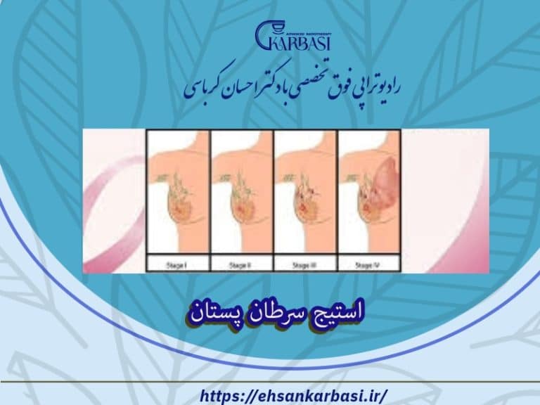 استیج سرطان پستان