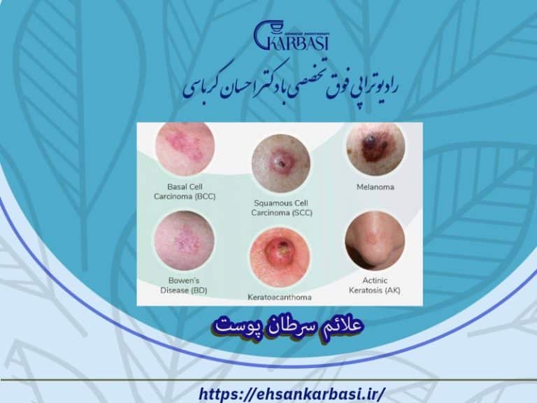 علائم سرطان پوست 2 علائم سرطان پوست