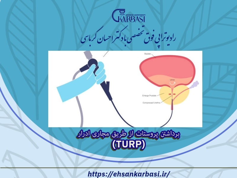 برداشتن پروستات از طریق مجاری ادرار (TURP)