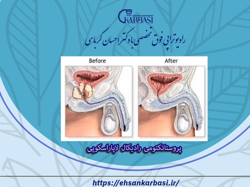 پروستاتکتومی رادیکال لاپاراسکوپی