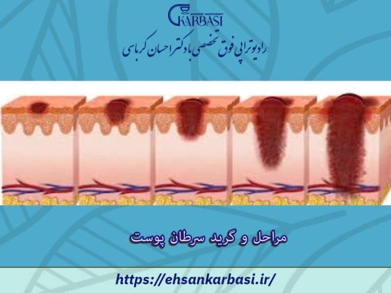 مراحل و گرید سرطان پوست 2 مراحل و گرید سرطان پوست