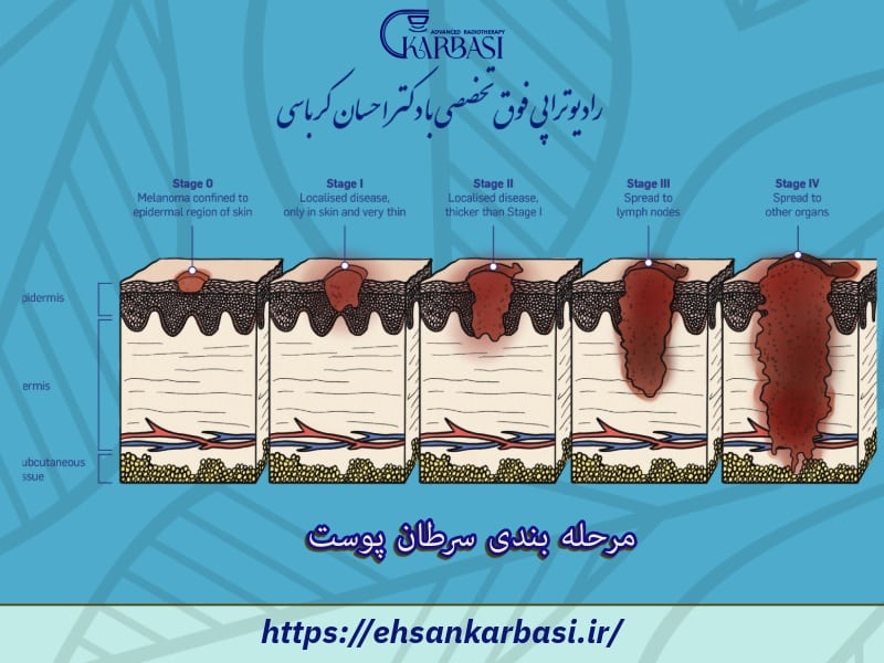 مرحله بندی سرطان پوست