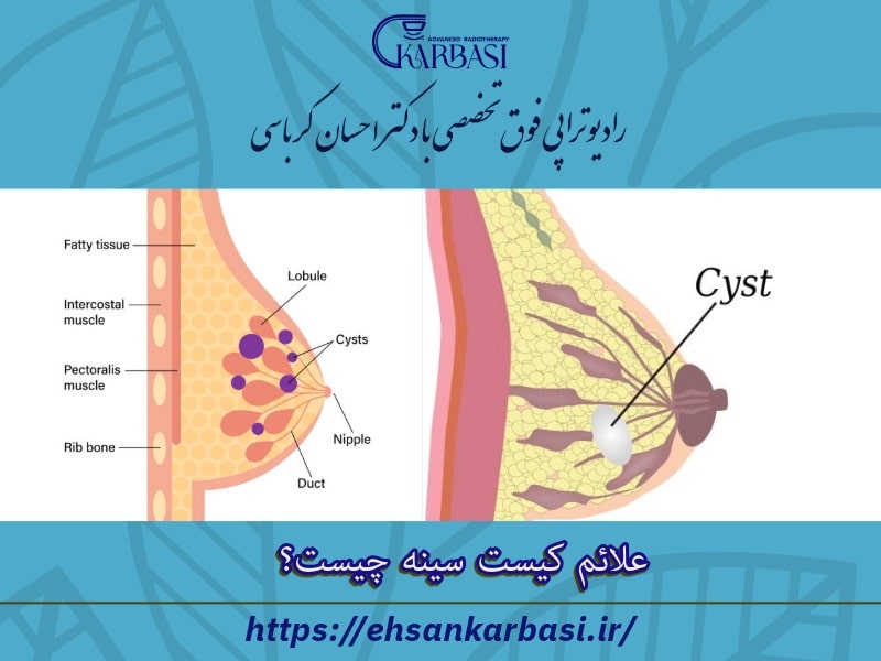 علائم کیست سینه چیست؟