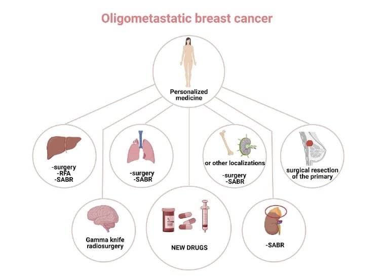 سرطان سینه الیگومتاستاتیک