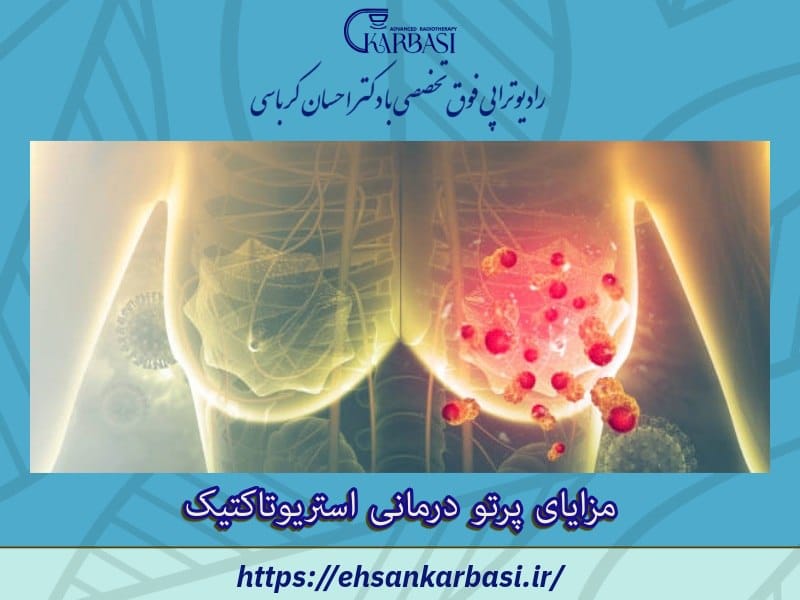 مزایای پرتو درمانی استریوتاکتیک برای سرطان پستان الیگومتاستاتیک