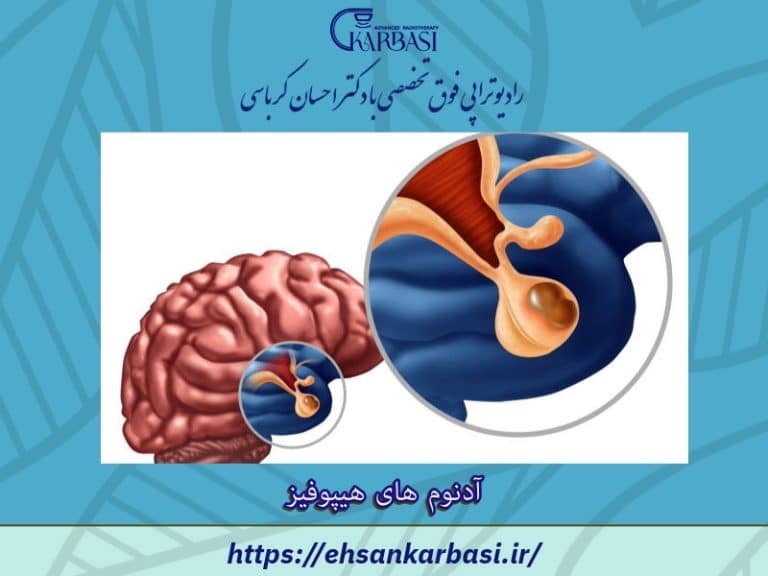 آدنوم های هیپوفیز | بهترین درمان تومور هیپوفیز 2 آدنوم های هیپوفیز یا تومور هیپوفیز
