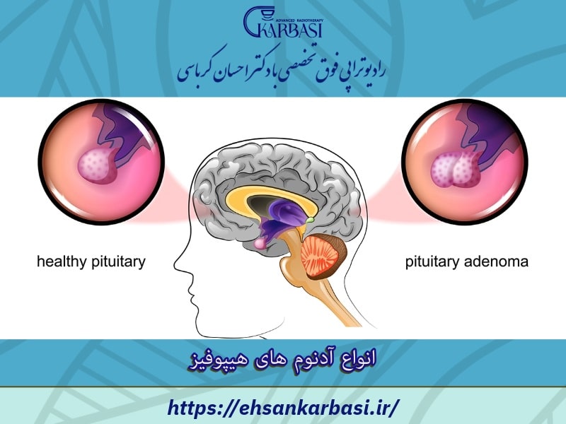 انواع آدنوم های هیپوفیز